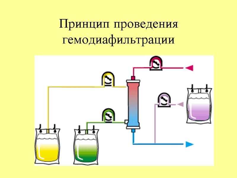 Принцип проведения гемодиафильтрации